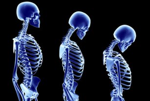 Cara Mencegah Osteoporosis Di Masa Tua